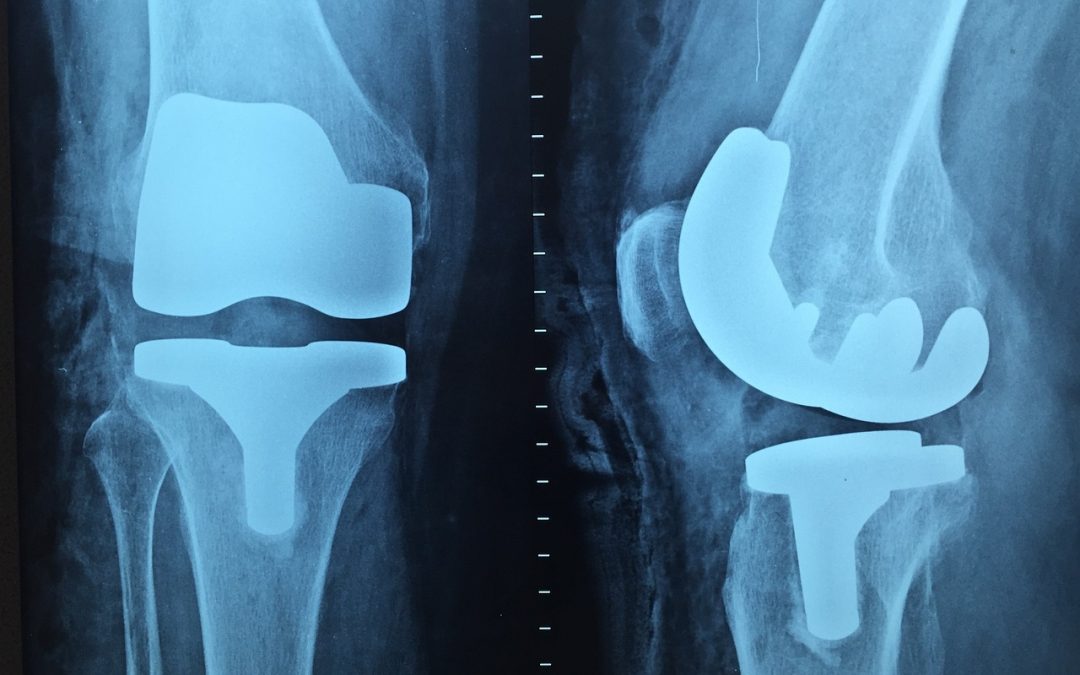 Chirurgien orthopédique : une garantie de soin pour les pathologies de la cheville